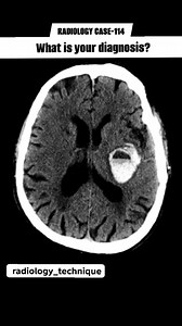 Radiology case-114 What is your diagnosis ? | Diwakar Patel