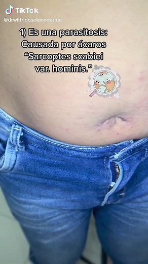 Todo sobre la Escabiosis: Causas, Síntomas y Tratamiento