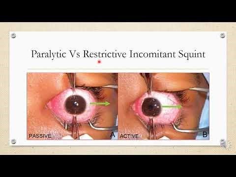 Differential diagnosis of Incomitant Squint