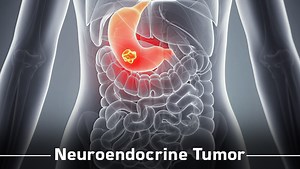 Neuroendocrine Tumor - Causes, Symptoms, Diagnosis, Prognosis, Treatment