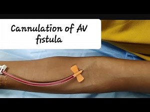 Cannulation of AV fistula, HOW to cannulate new AV fistula?