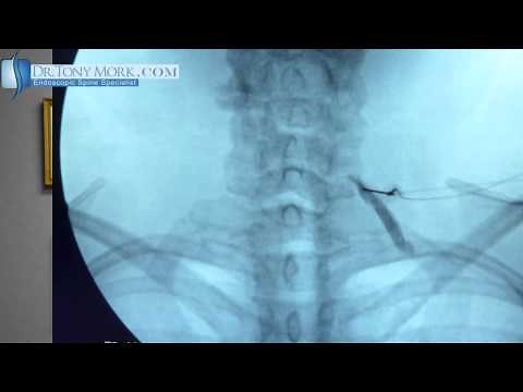 Spinal Pain Mapping of Cervical Spine Nerve Root