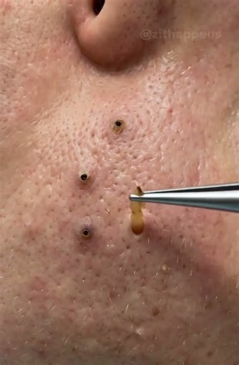 The Most Satisfying Deep Blackhead Extraction You’ll Ever See #PoreClearing #Skincare #AcneTreatment