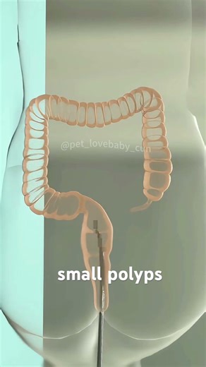 How Colonoscopy is performed? (3D Animation)#colonoscopy #colonoscopyday #colonoscopyday