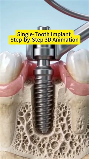 Single‑Tooth Dental Implant Step‑by‑Step 3D Animation｜How Implants Are Done