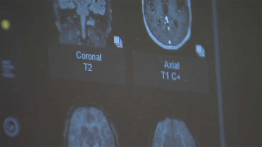 Progressive supranuclear palsy and how awareness of the disease can move toward more therapies