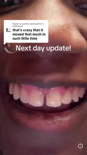 Experiencing Life with Retainers: My Journey