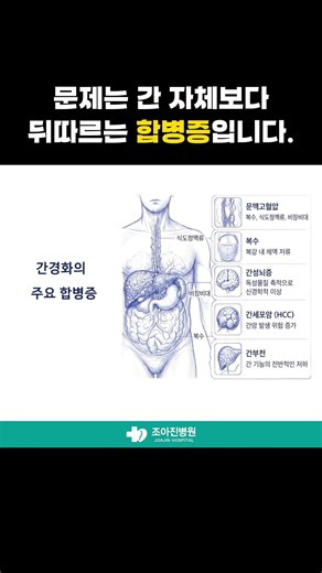 간경화, 간만의 문제가 아닙니다 | 합병증 관리가 중요한 이유