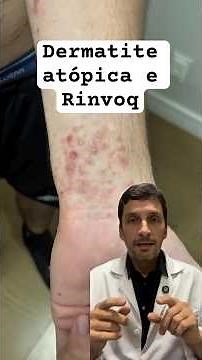 Severe atopic dermatitis improves GREATLY with Rinvoq #atopicdermatitis #dermatitis #rinvoq #eczema