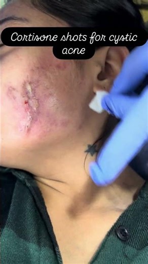 Cortisone shots cystic for acne ….#shorts #viral #trending #skincare #youtubeshorts