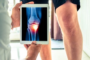 Arthrose :  symptômes et traitements de cette maladie articulaire