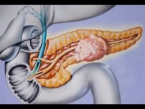 Non-functioning Pancreatic neuroendocrine tumors (PNET)