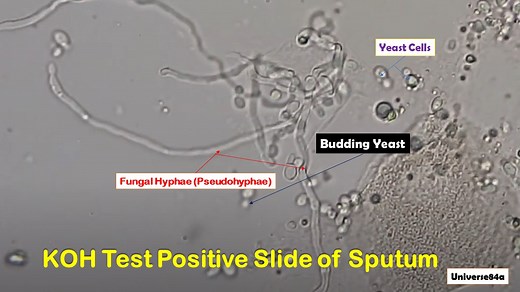 KOH Test Positive Slide of Sputum: Introduction, Principle, Procedure
