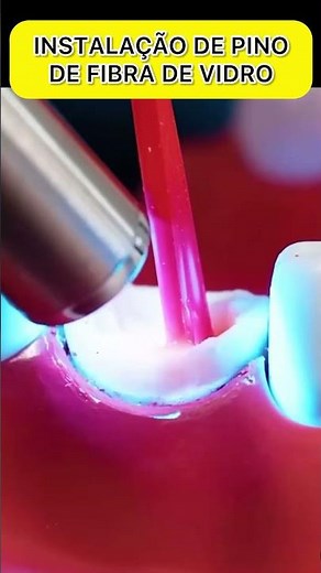INSTALAÇÃO DE PINO DE FIBRA DE VIDRO #pinodental #protese #resumosdeodonto #dentista #siso #odontolo