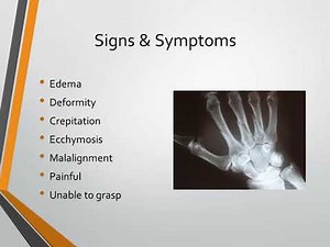 Metacarpal Fracture