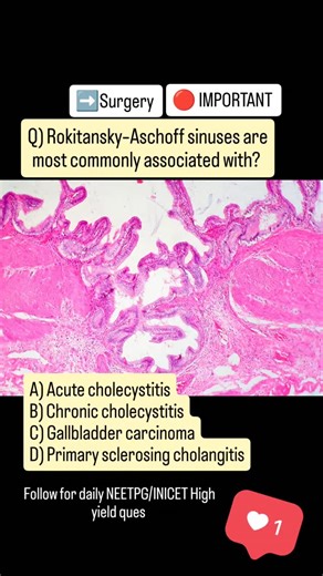 Case2Concepts | Rokitansky - Aschoff sinuses are most commonly associated with ? #neetpg #fmge #inicet #surgery #usmle | Instagram