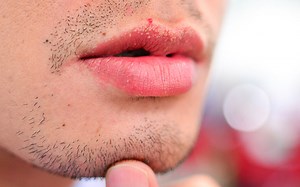 Fordyce Spots On Lips: How Does It Look?   Causes & Treatments