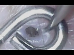 Dilated pore of winer - Aug 4 video