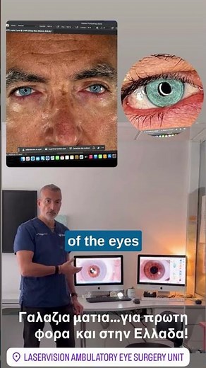 First Successful FLAAK Eye Color Change Procedure in Greece #drkanellopoulos #laservisiongr