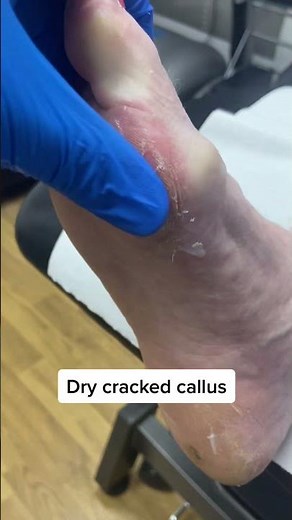 Watch this Aussie podiatrist transform feet! Dry cracked callus removal with a scalpel.