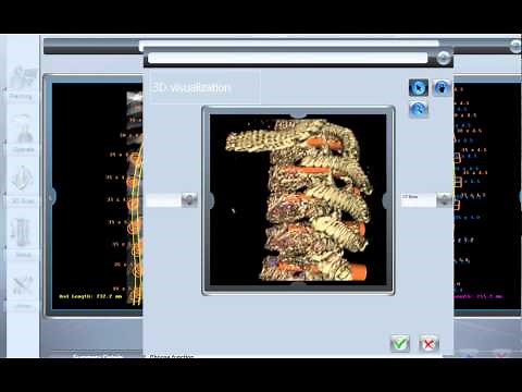 Mazor Robotics CT based 3D planning for spine surgery