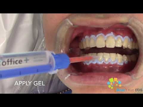 In-Office Teeth Whitening (1 round out of 3)
