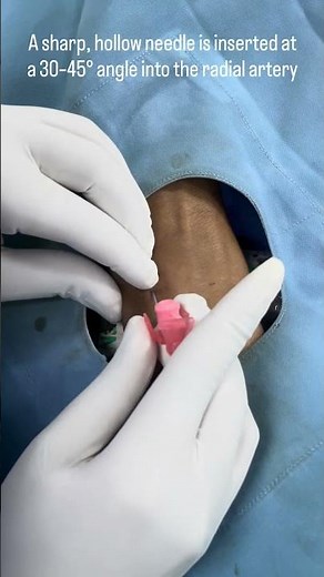 “Radial Artery Access | Modified Seldinger Technique in 60 Seconds”