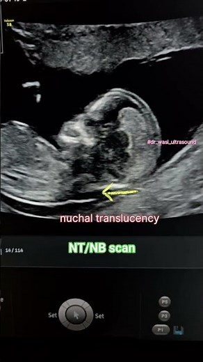 NT/NB Scan #dr_wasi_ultrasound #ntnbscan #ultrasonography