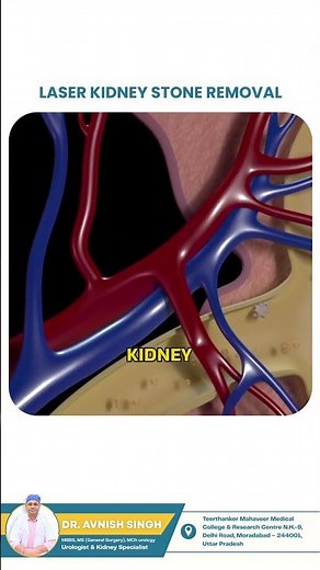 Kidney Stones Explained: Causes, Pain & When Surgery Is Needed | Urologist Advice