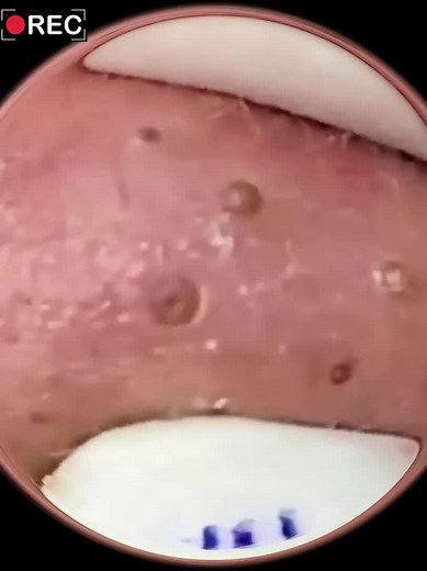 #blackhead #squeeze #ance #pimple #pimpleopop #foryoupage #viral #tiktok #satisfying #backhead #squeezeyuk
