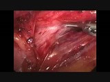 Laparoscopic Nissen Fundoplication • Video • MEDtube.net