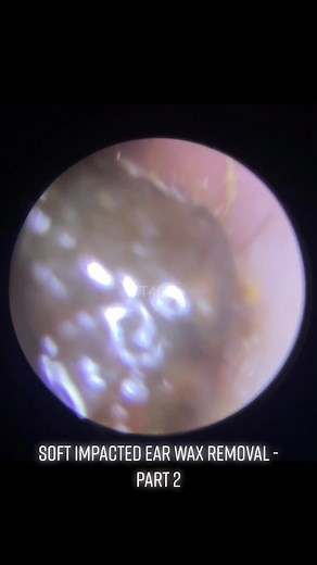 SOFT IMPACTED EAR WAX REMOVAL - PART 2 #ear #earwax #earwaxremoval #earcleaning #audiology #audiologytiktok #wales #waxvent #satisfying