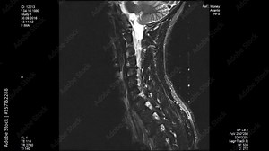 MRI scans, lumbar spine closeup