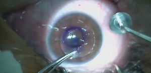 The Power of CTAK: Significantly Improving Vision for Mild Keratoconus - Eyetube