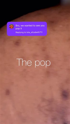 Parish HS on Instagram: "I caught the pop of my back abscess that’s been hanging around for a long time… it was interesting what came out #hidradenitissuppurativa #hidradenitissuppurativaawareness #hidradenitissuppurativawarrior #hswarrior"