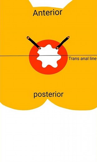 Goodsall's law of Peri Anal Fistula