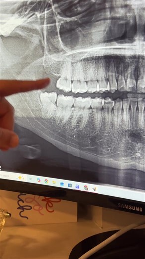 Surgical Extraction of Lower Wisdom Tooth Explained
