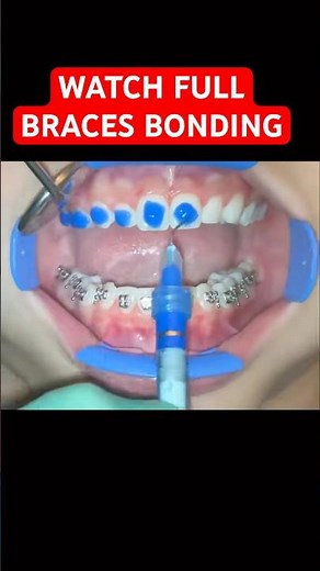 Braces in 45 Seconds: Full Upper & Lower Arch Bonding
