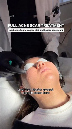 FULL Acne Scar Treatment for Ice Pick + Boxcar Scars with Dr. Qazi | Part One: Diagnosing the Scars