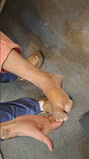 Clonus | Exaggerated knee reflex | Upper motor neuron signs | CVA patient #clinicalexamination