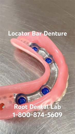 Locator Bar with Over Denture #dentist #dentallab #dentures #denturelife #smiledesigndental