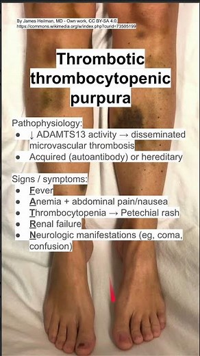 Thrombotic thrombocytopenic purpura (TTP)