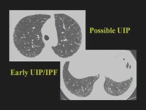 HRCT of Diffuse Lung Disease - HD [Basic Radiology]