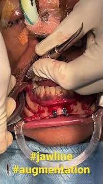 Entire 3D Bony Permanent Jaw Line Augmentation From Angle to chin Surgery by Dr sunil Richardson