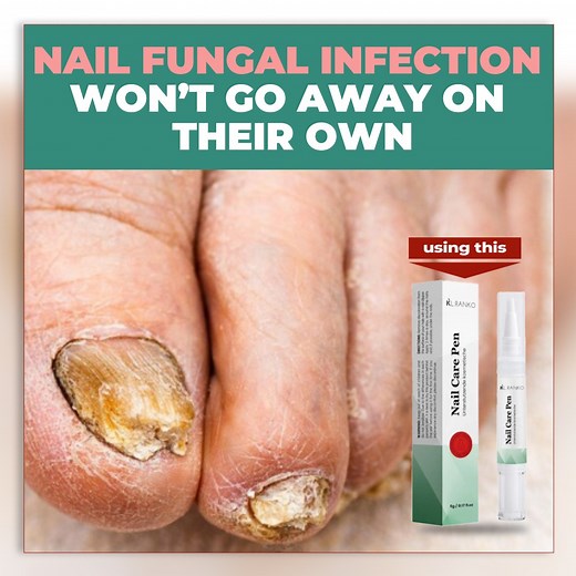 Tired of brittle, discolored, or infected nails that just won’t heal? Meet the Nail Care Pen — your easy, mess-free solution for stronger, clearer, and healthier nails! 💅 ✅ Fights nail fungus fast ✅ Restores natural shine ✅ Strengthens nails and cuticles ✅ Easy to apply — anytime, anywhere No more hiding your nails. Let them shine again with confidence! 🌸 👉 Order now — Pay on Delivery! | Nail Fungal Relief