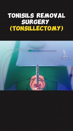 How Tonsillectomy Procedure Is Performed? | Tonsillectomy Procedure 3D Animation #tonsillectomy #tonsillectomyrecovery #tonsilstones #tonsilremovalsurgery #tonsilremoval #tonsilsremoved #tonsilremoved #tonsilstone #tonsilstonesremoval #tonsilstones🤮👃🏽 #medicalprocedure #medical3danimation #3dmedicalanimation