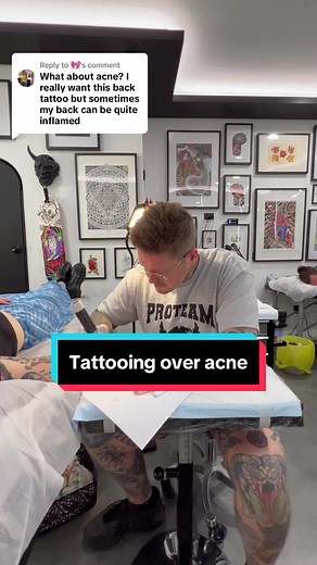 Can You Tattoo Over Acne? Important Considerations