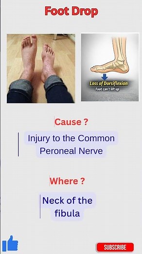 Foot Drop = Fibula Neck Injury? Common Peroneal Nerve Explained #shorts
