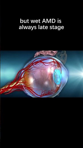 What are the types and stages of AMD - Wet AMD