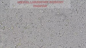 Giardia lamblia cyst identification in stool microscopy....